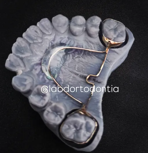 Barra transpalatina com botão de Nance · LAB-D